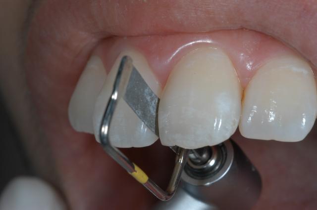 予防 矯正 審美 インプラントブログ 星野歯科駒沢クリニック アクアシステム マウスピース型矯正装置